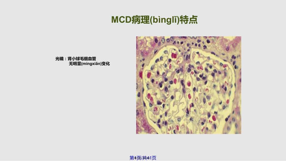 肾小球微小病变病实用教案实用教案_第1页