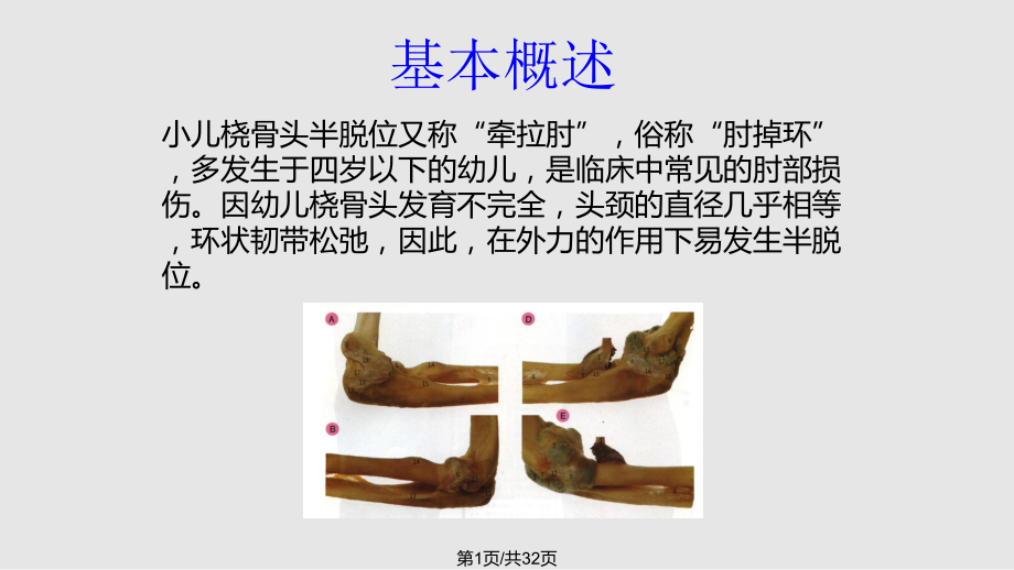 桡骨头半脱位伤科学PPT课件_第1页