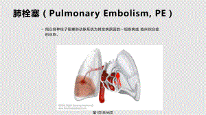 肺栓塞的诊疗PPT课件