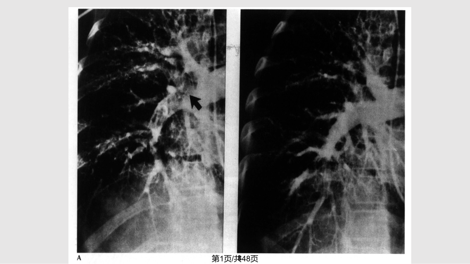 肺栓塞的诊断与治疗新进展PPT课件_第1页
