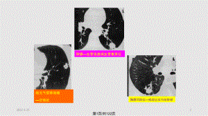 肺肿瘤王旭PPT课件