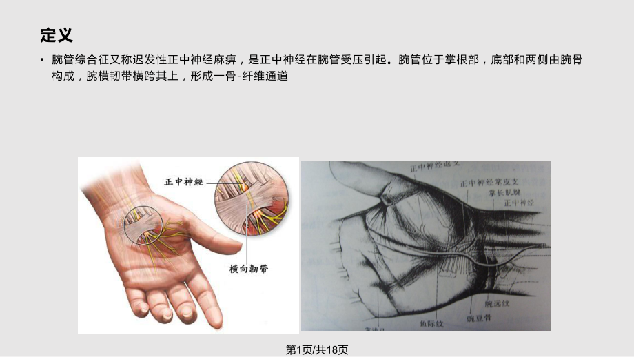 腕管綜合癥 護(hù)理查房PPT課件_第1頁