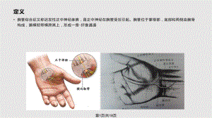 腕管綜合癥 護理查房PPT課件