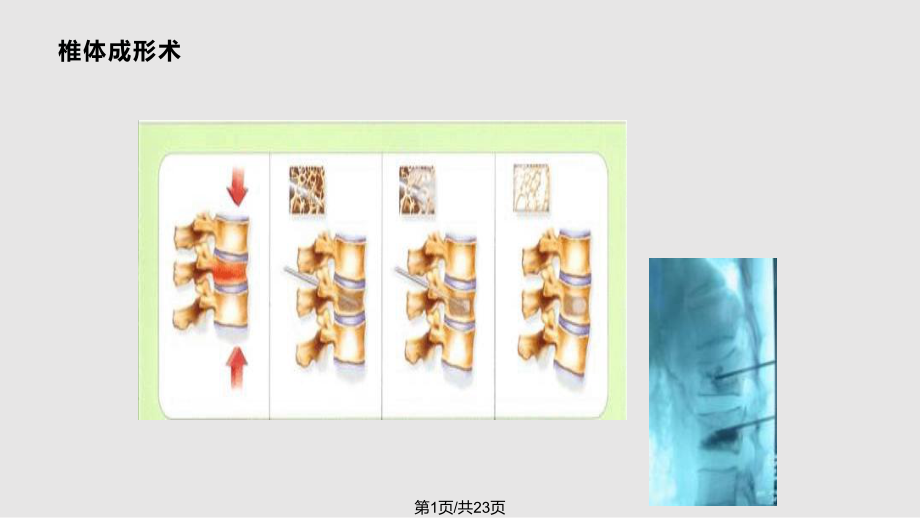 經(jīng)皮椎體后凸成形術(shù)PPT課件_第1頁(yè)