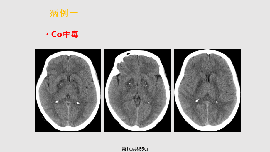颅脑常见病变的CT诊断PPT课件_第1页