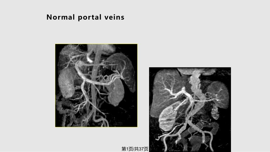 门静脉海绵样变PPT课件_第1页