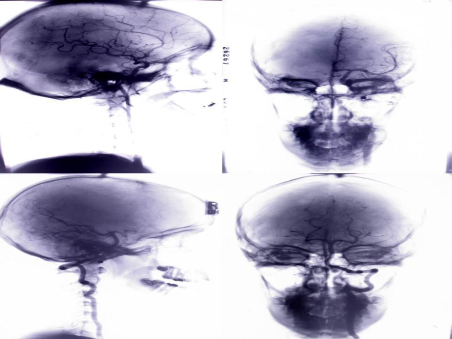 《腦血管造影》PPT課件.ppt_第1頁(yè)