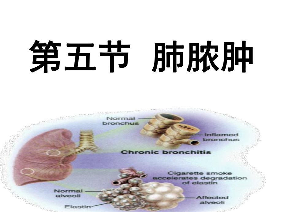 内科护理学_课程课件_4.肺脓肿_第1页