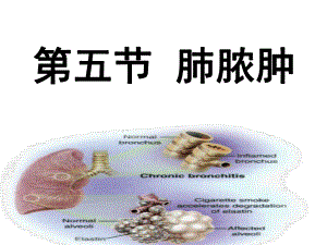 内科护理学_课程课件_4.肺脓肿