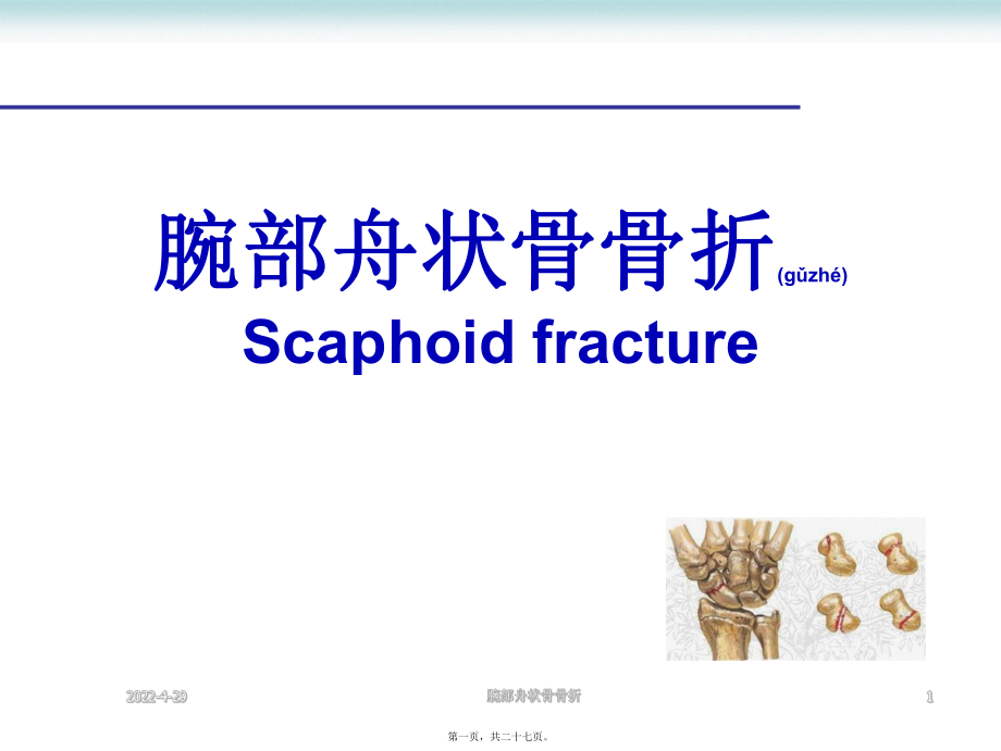 腕部舟状骨骨折课件_第1页