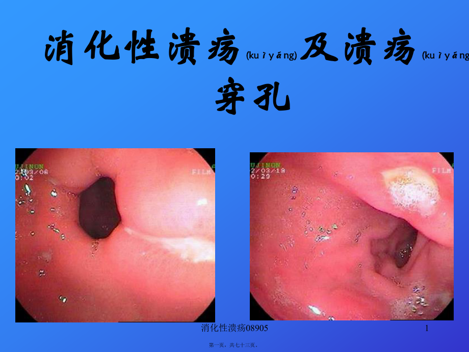 消化性溃疡08905课件_第1页