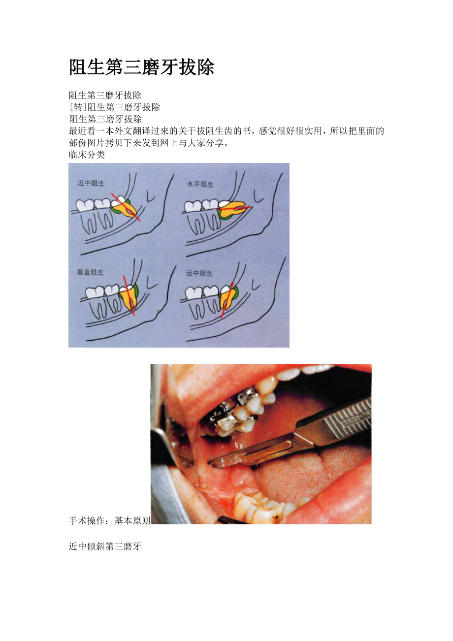 一起學(xué)之阻生第三磨牙拔除_第1頁