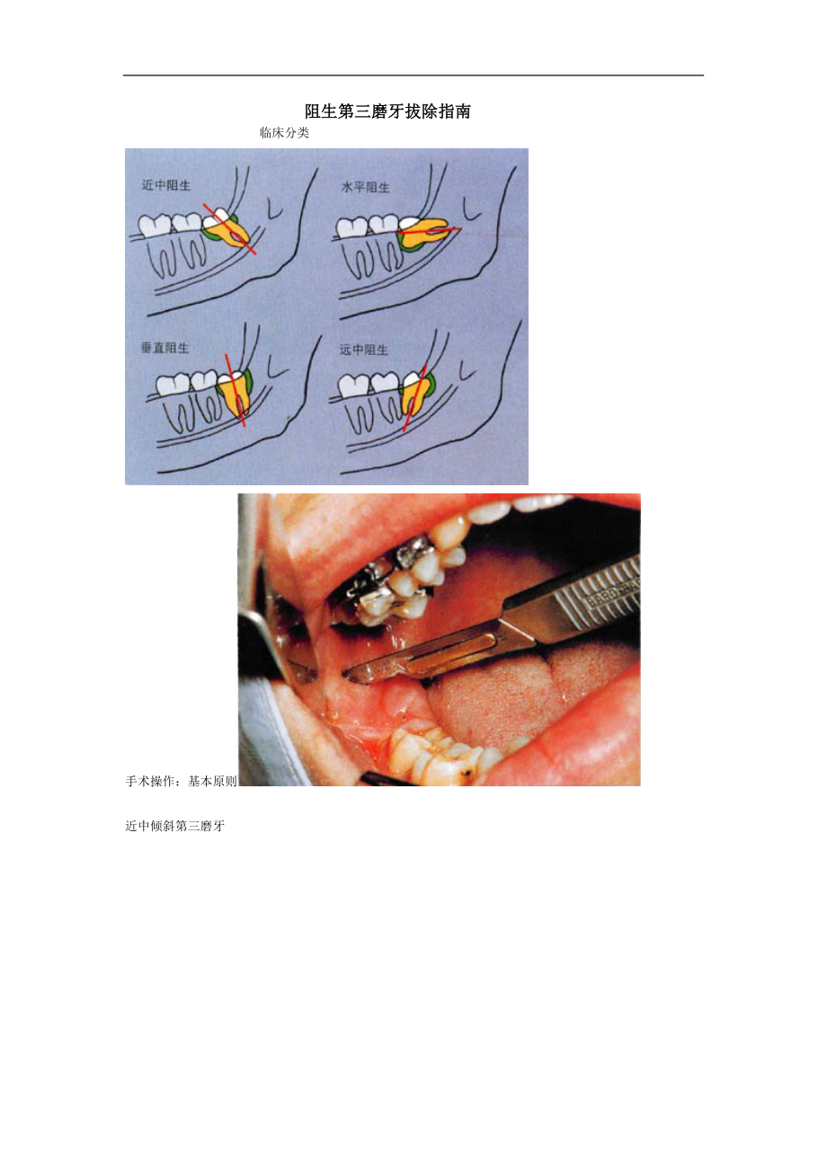阻生第三磨牙拔除指南_第1頁