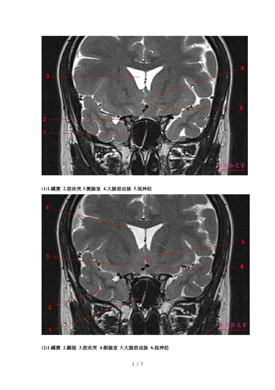 鞍区垂体MRI解剖_第1页