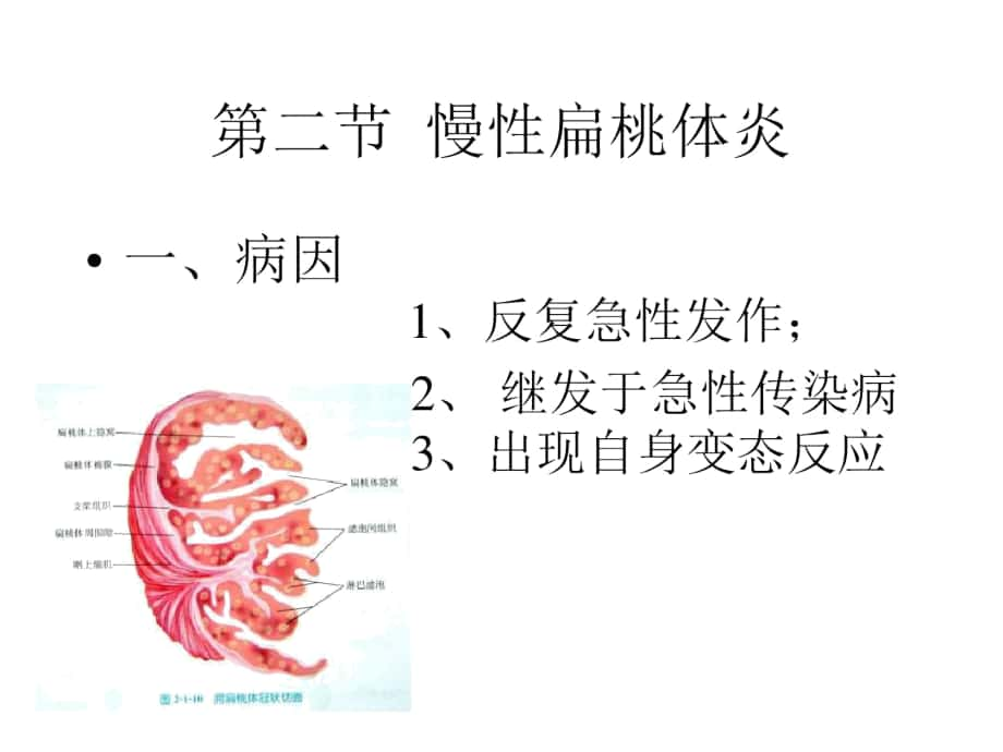 扁桃体切除术手术适应症1扁桃体炎反复急性发作或多次_第1页