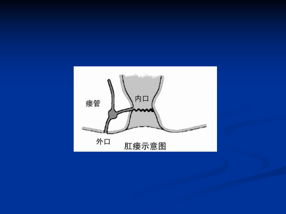 肛瘘手术动画演示图片