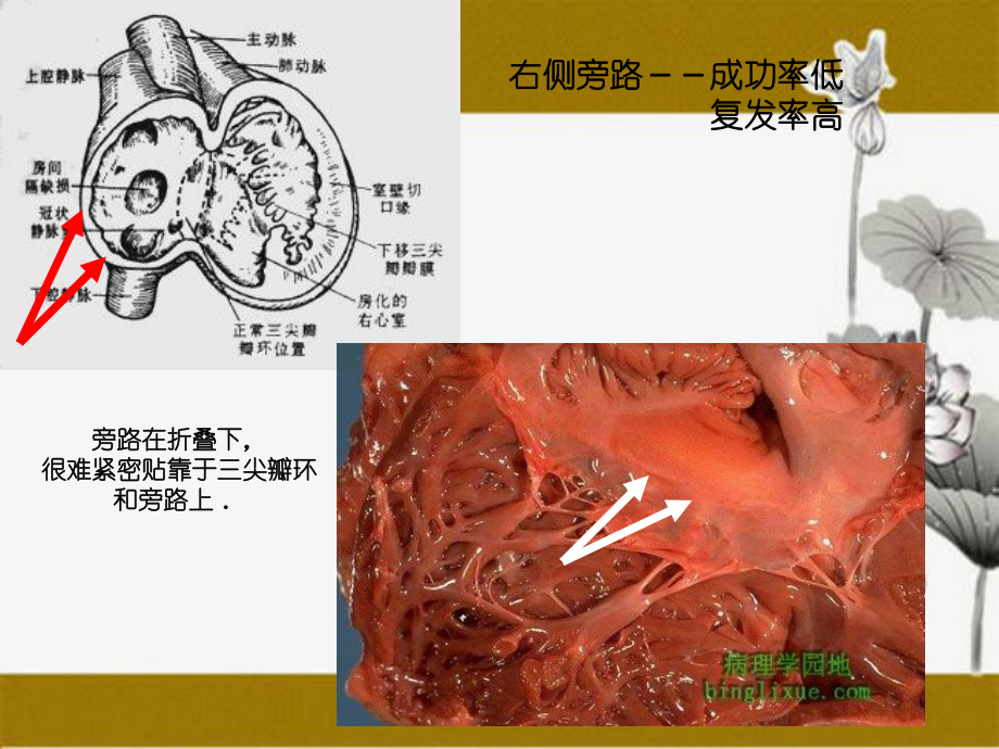 第三尖瓣环点钟大头到位技巧_第1页