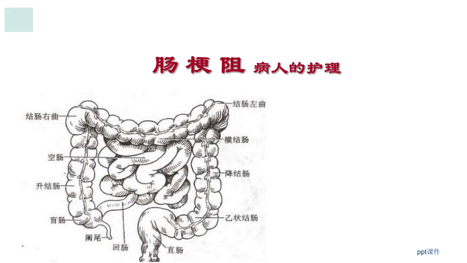 外科护理学-肠梗阻病人的护理课件_第1页