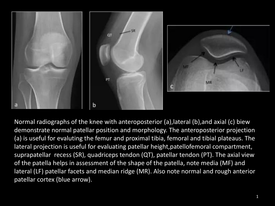 髌骨病变的影像学表现课件_第1页