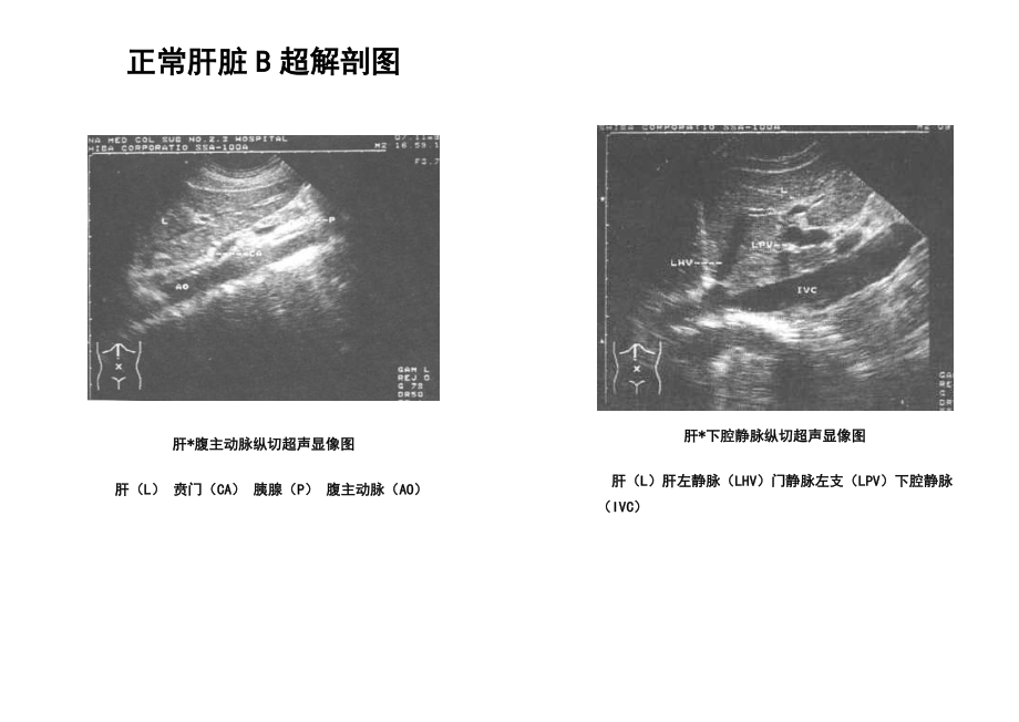 正常肝脏解剖图(B超)_第1页