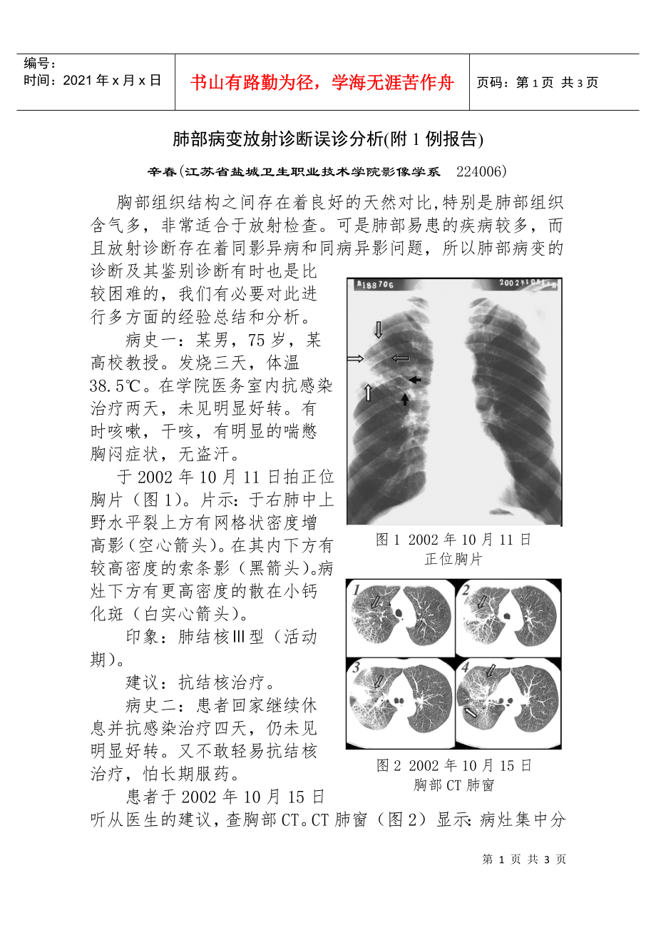 肺部病变放射诊断误诊分析doc-肺部病变放射诊断误诊一例_第1页